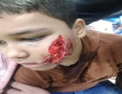 ਸੂਈ ਕੁੱਤੀ ਨੇ 15 ਲੋਕਾਂ ਨੂੰ ਨੋਚਿਆ; 11 ਸਾਲਾ ਬੱਚਾ ਸੀਐੱਮਸੀ ਰੈਫ਼ਰ