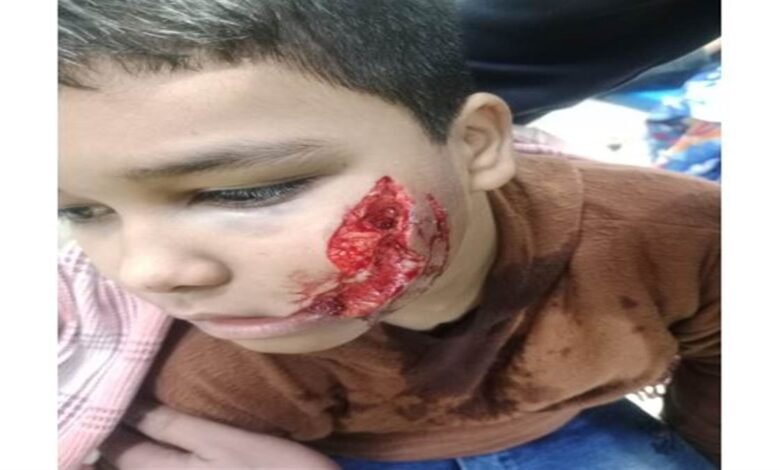 ਸੂਈ ਕੁੱਤੀ ਨੇ 15 ਲੋਕਾਂ ਨੂੰ ਨੋਚਿਆ; 11 ਸਾਲਾ ਬੱਚਾ ਸੀਐੱਮਸੀ ਰੈਫ਼ਰ