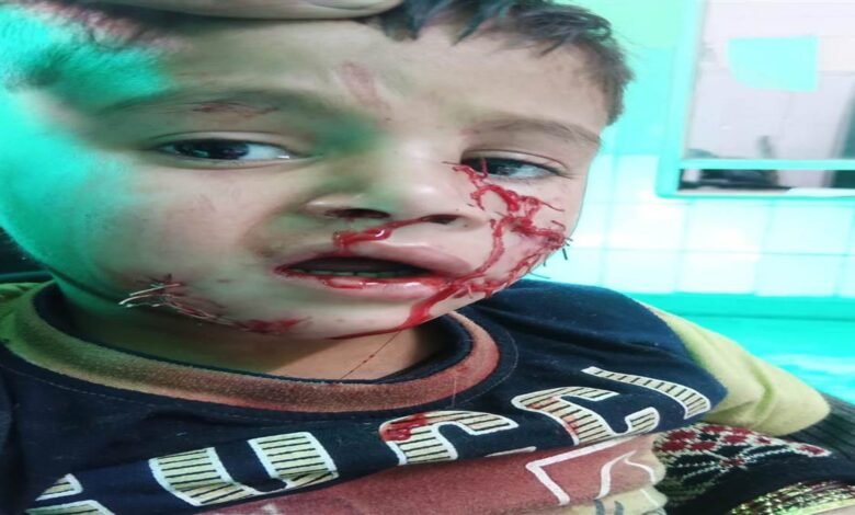 ਚਾਰ ਸਾਲਾਂ ਦੇ ਮਾਸੂਮ ਬੱਚੇ ਨੂੰ ਅਵਾਰਾ ਕੁੱਤਿਆਂ ਨੇ ਬੂਰ ਤਰ੍ਹਾਂ ਨੋਚਿਆ ਚਾਰ ਸਾਲਾਂ ਦੇ ਮਾਸੂਮ ਬੱਚੇ ਨੂੰ ਅਵਾਰਾ ਕੁੱਤਿਆਂ ਨੇ ਬੂਰ ਤਰ੍ਹਾਂ ਨੋਚਿਆ