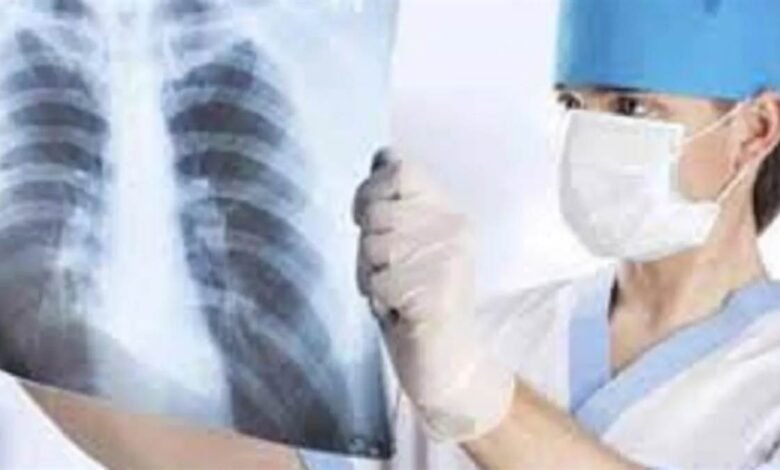 ਚੰਡੀਗੜ੍ਹ ’ਚ ਵਧ ਰਿਹਾ ਟੀਬੀ ਦਾ ਖ਼ਤਰਾ